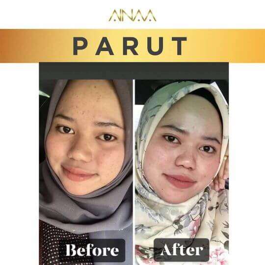 Parut Jerawat 4