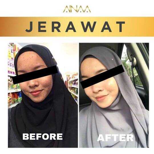 Jerawat 2
