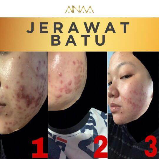 Jerawat Batu 2